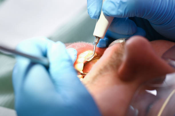 Best Dentist for Tooth Abscess  in Durand, MI